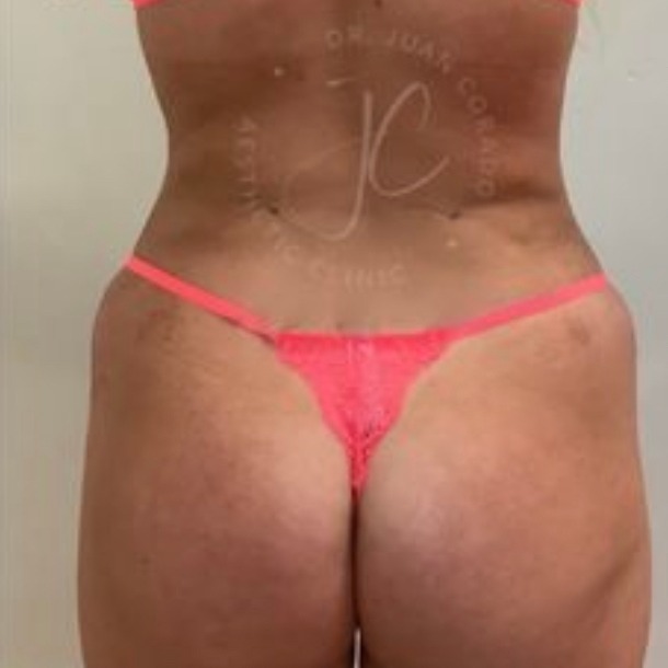 LipoDefine