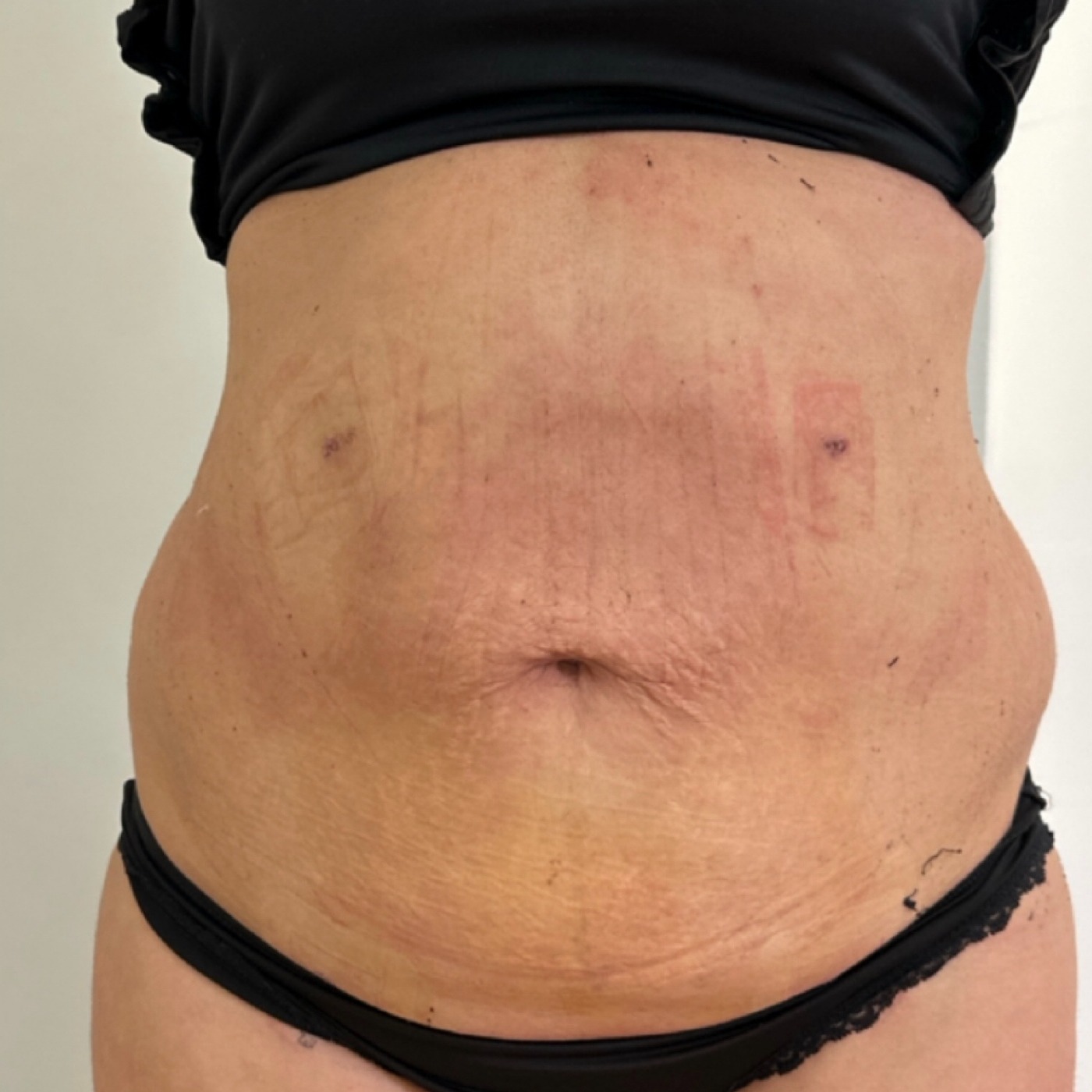 LIPODefine