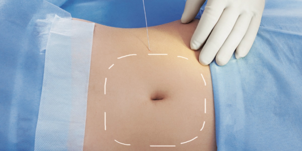 Screenshot-2023-10-25-at-14.39.26 laser-assisted lipolysis