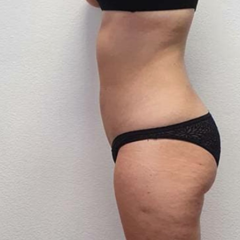 LIPODefine after