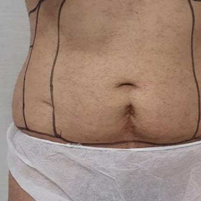 LIPODefine before