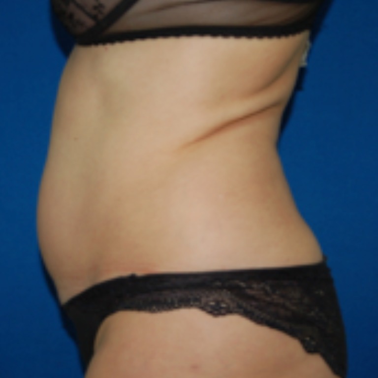 LIPODefine after