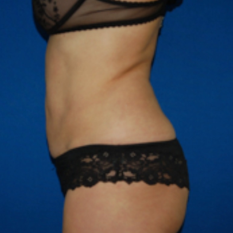 LIPOdefine after