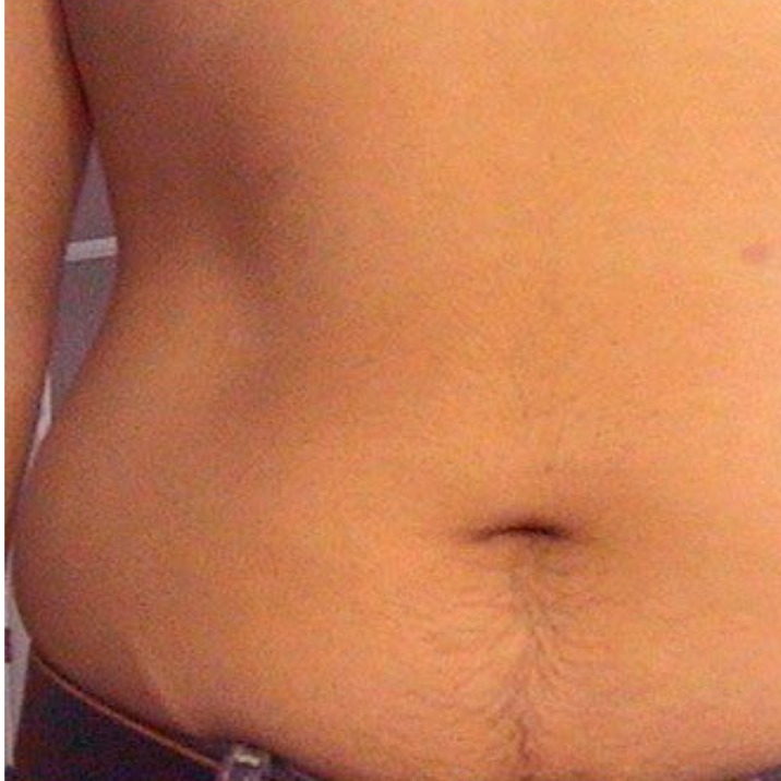 LIPODefine