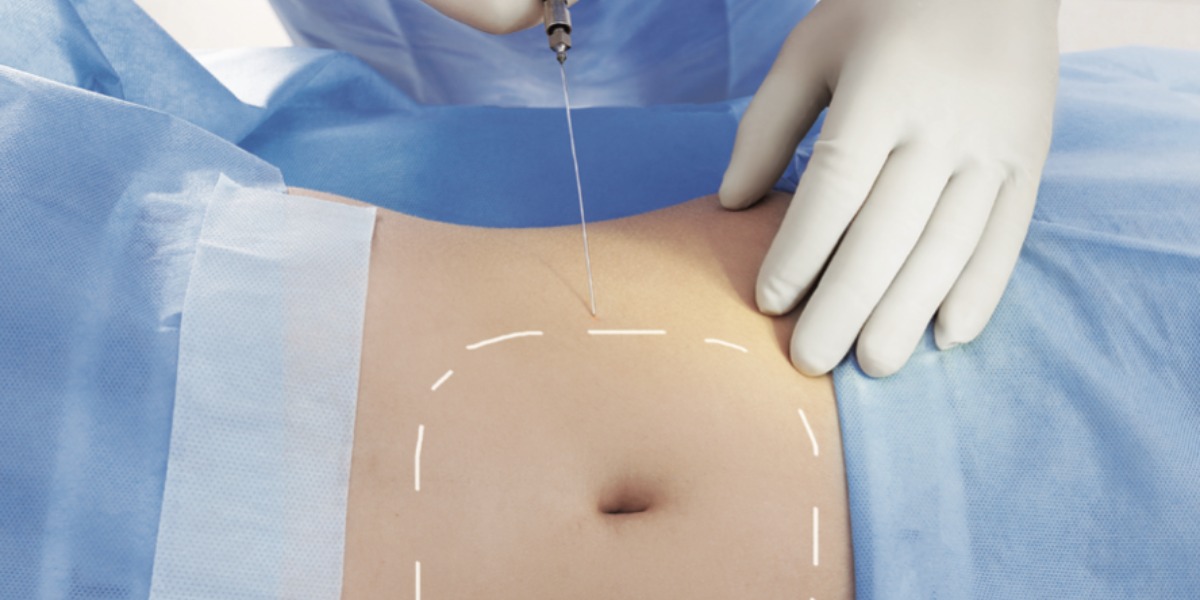 LipoDefine treatment