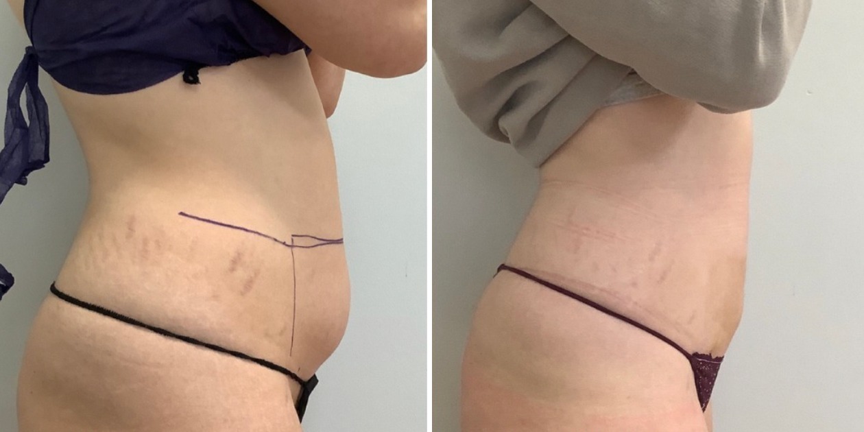 Before and after LipoDefine treatment Before and after lower abdomen LipoDefine treatment.