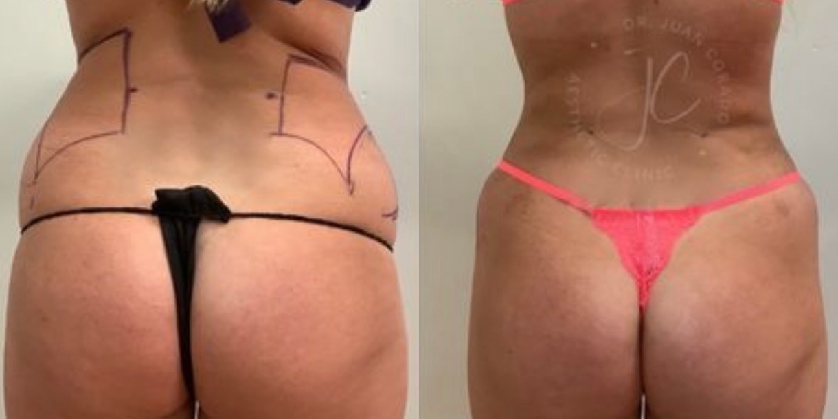 LipoDefine Before And After Treatment