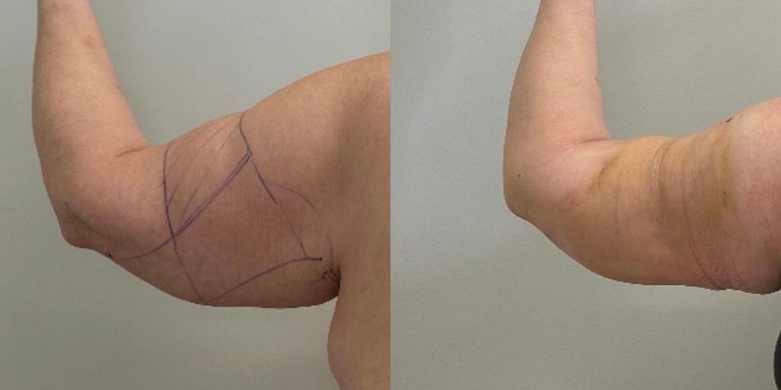 LipoDefine Treatment Results Results from LipoDefine treatment of the upper arms