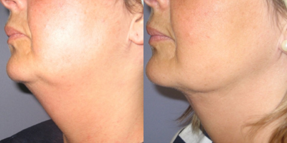 Results from EndoDefine