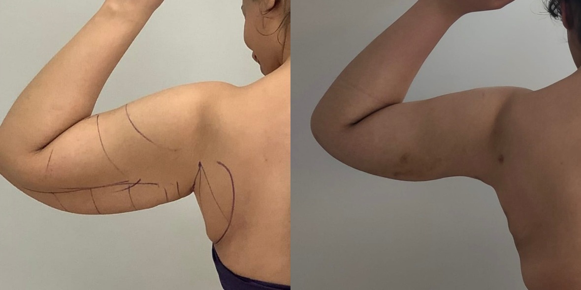 Results from LipoDefine treatment Results from LipoDefine treatment of upper arms.